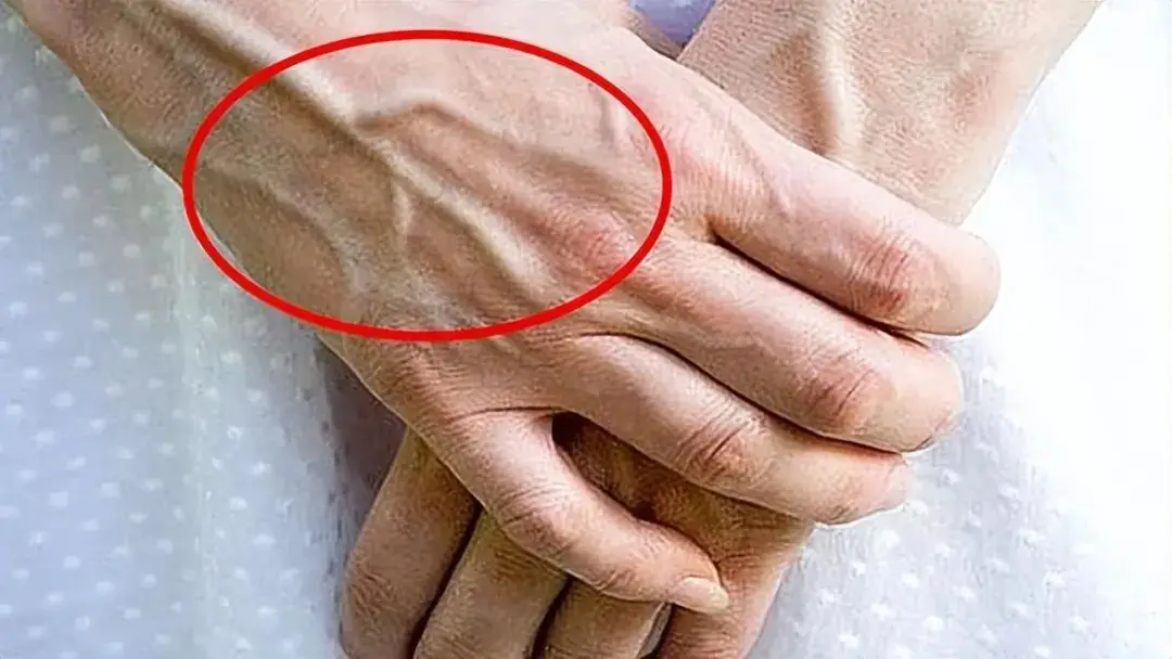 有的人手臂"青筋暴起",而有的人几乎看不到青筋,哪种更健康_血管_静脉