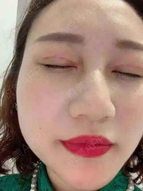 户外真的太热了只有在室内活动,活动术后17天恢复得很好效果也慢慢的