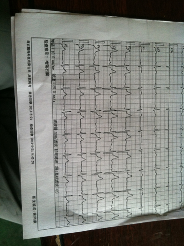 心电图 检测:电轴右偏,严重吗?还有舒张压59,收缩压110,脉搏73!请专家