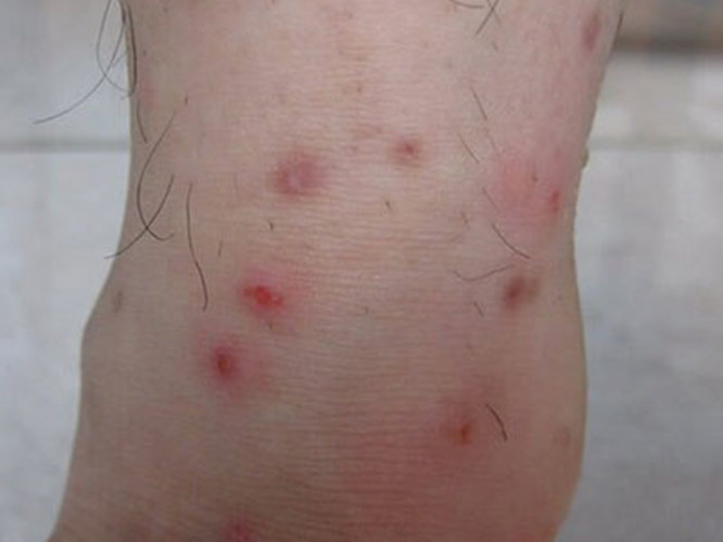 一期梅毒初期生殖器图片