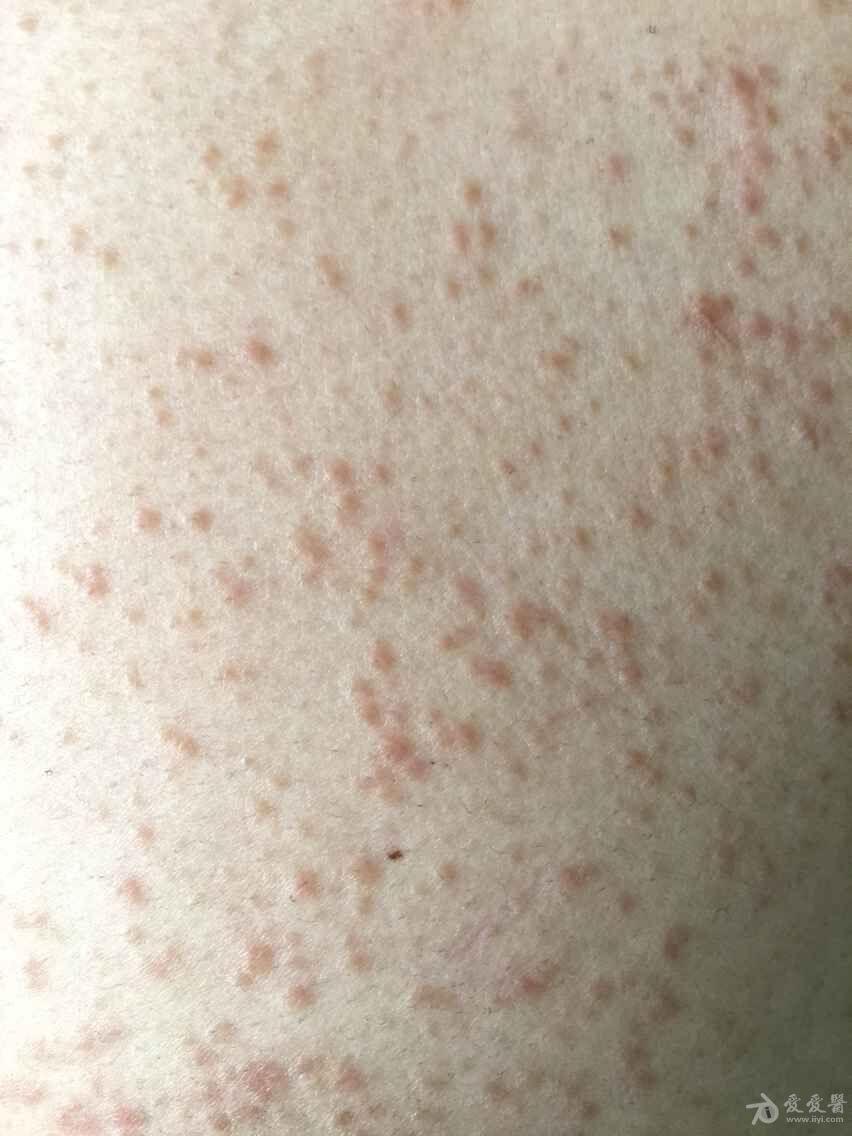 69 ★临床第三区 69 皮肤及性传播疾病讨论版 69 胸腹部丘疹8年