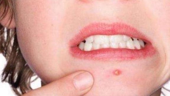 梅毒的"潜伏期"是多久?