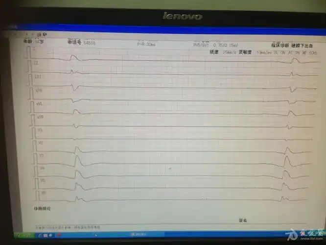 车祸死亡病人的心电图