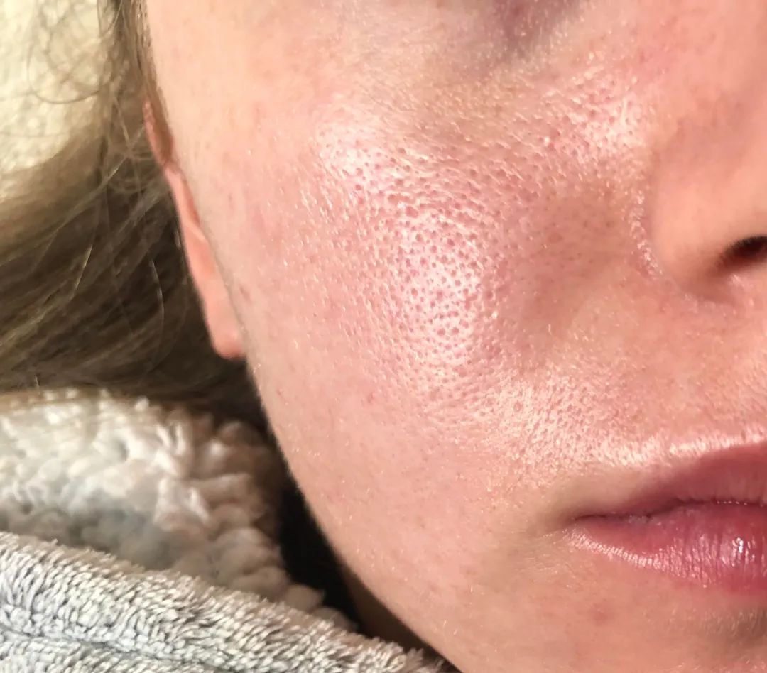 毛孔粗大的原因及解决方法,用哪款水光解决毛孔粗大?