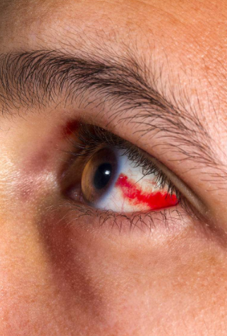 眼睛流血图片 (2)_有来医生