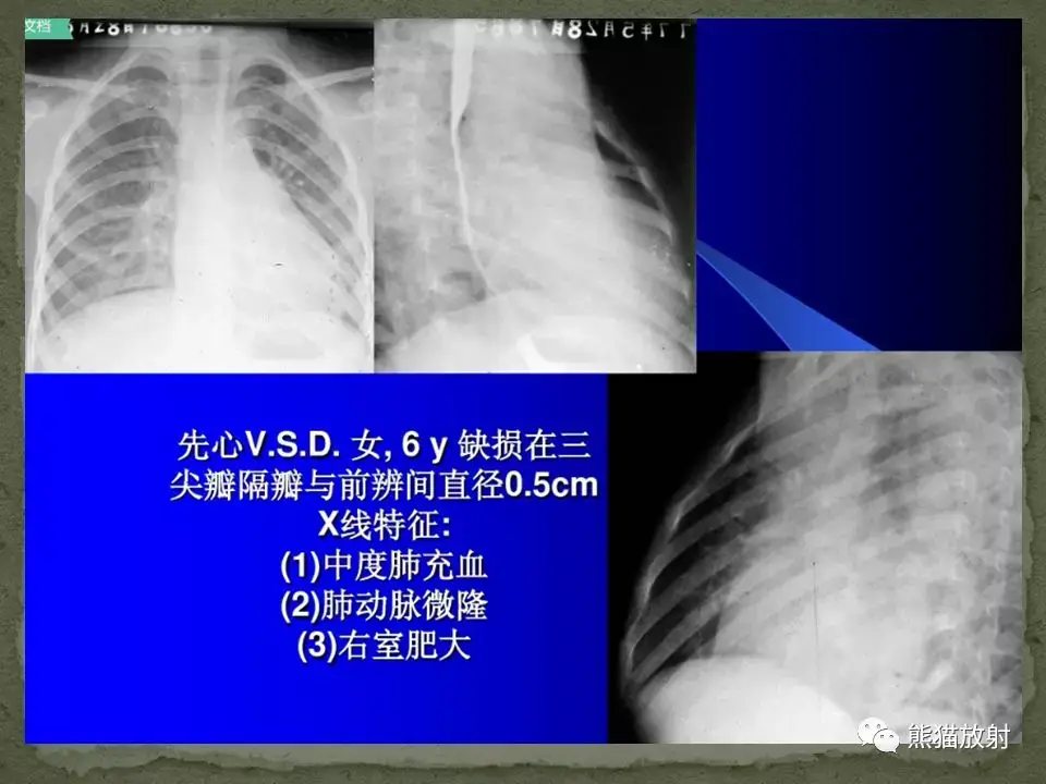 心脏和大血管病变的x线表现_肺静脉