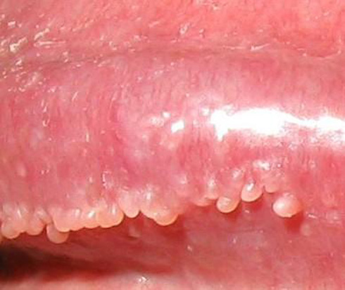 在阴茎的冠状沟处环绕龟头出现的淡红色小丘疹.