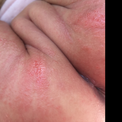 请各位宝妈帮帮忙,我孩子1岁2个月,估计是尿布疹好严重,用什麼方法好