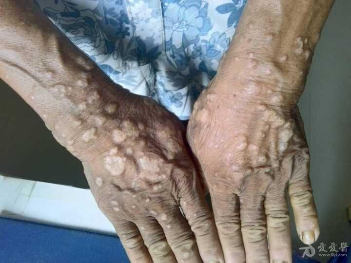 看图诊断寻常疣