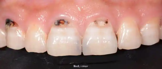 11 21邻面龋,唇侧颈部龋