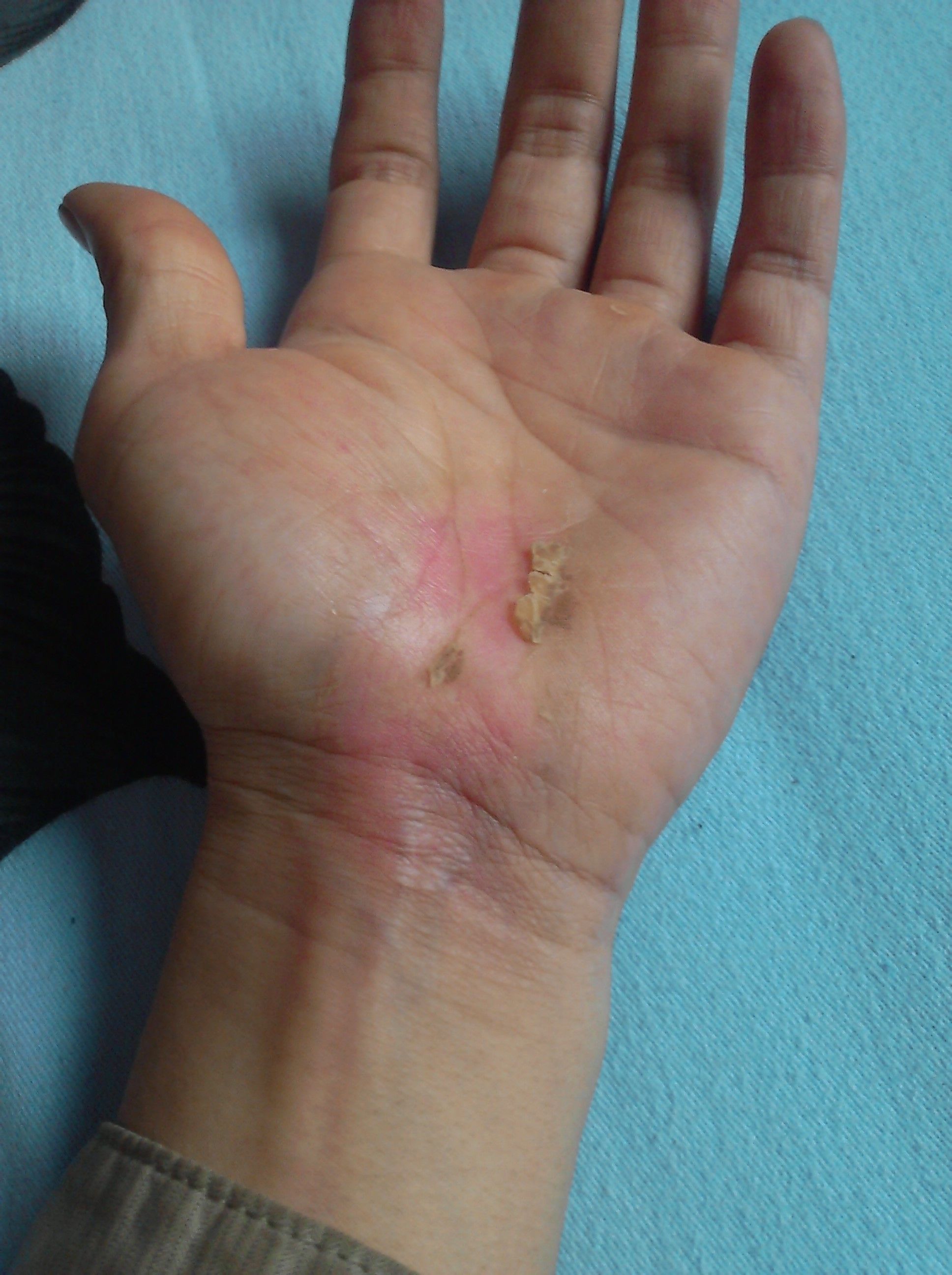 4 2008-08-12 脸部一度烧伤肤色会恢复原来的肤色吗 3 2009-07-17