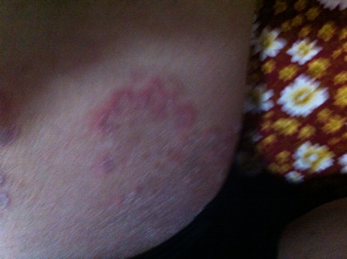 生殖器周围长了很多大片的红块,稍微凸起