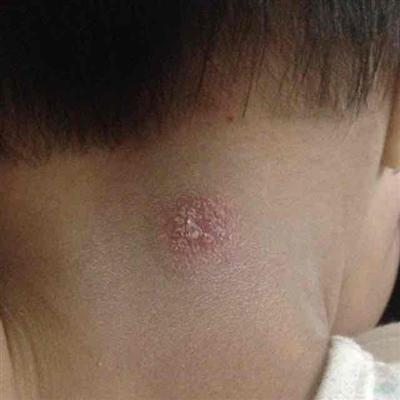 儿童牛皮癣初期的症状表现