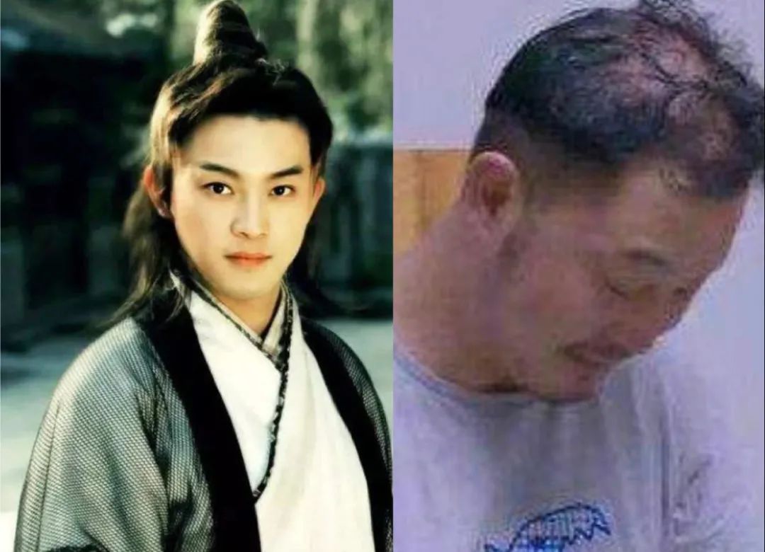 脱发困扰,胡歌发际线堪比吴彦祖,何炅头发稀疏能见头皮_假发_沙溢