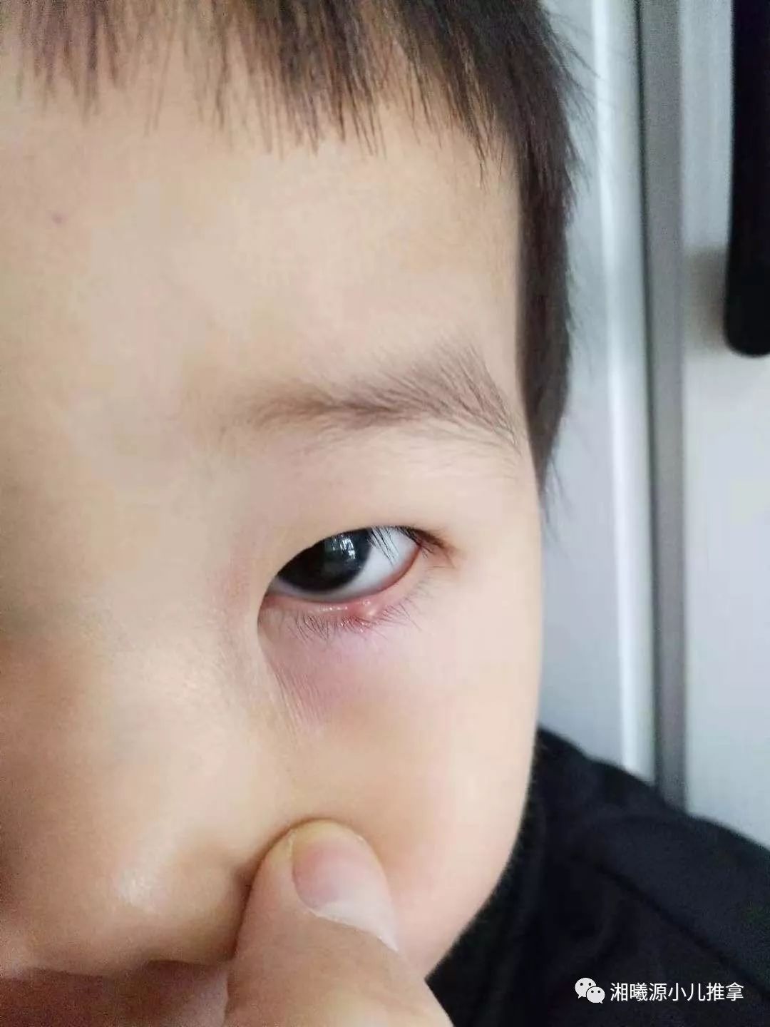 学员真实案例分享—豆豆20天的麦粒肿战斗