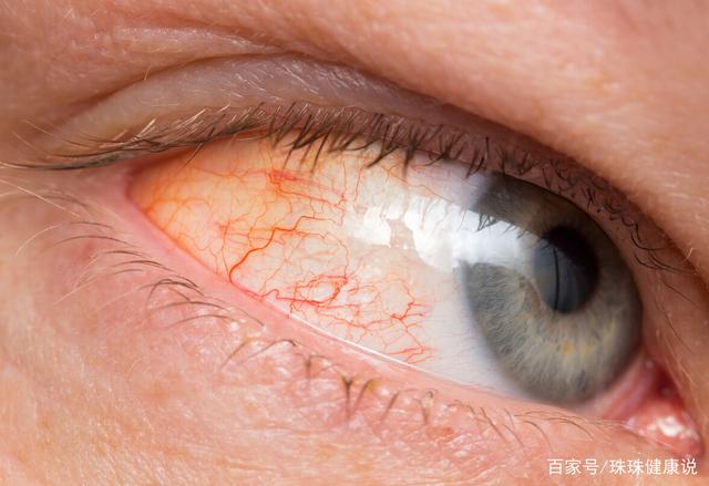 肝好不好,看眼睛就知道,眼出现4个"异常",可能是肝在求救