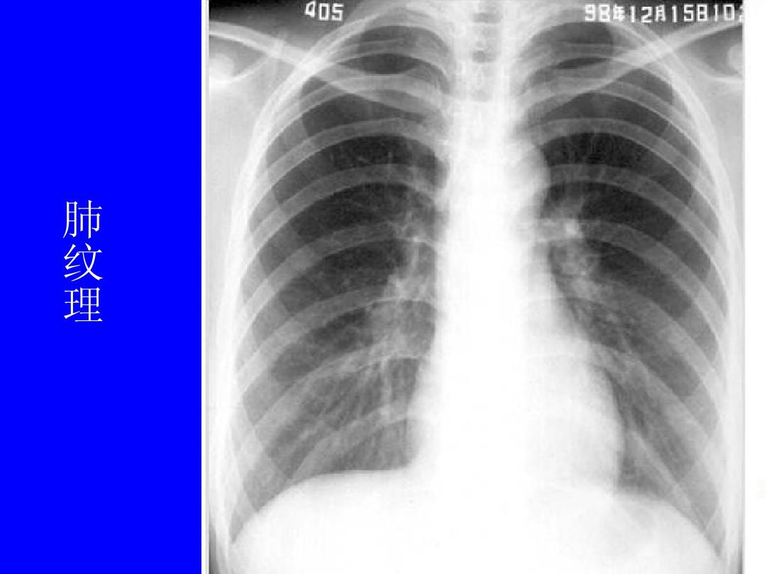 肺部正常和x线异常表现ppt