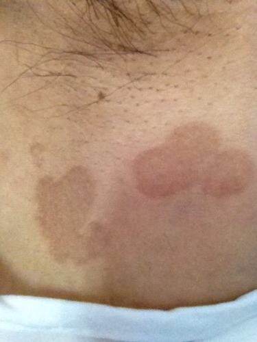 我腋窝下长了这时什么?两边都有,大小不等,去年冬天就有了