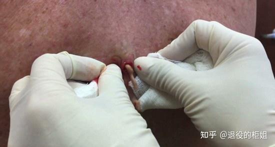 挤粉刺挤出来的东西很臭但是又让人很想闻这个气味是什么