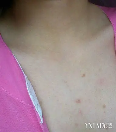 【图】胸口长痘痘怎么回事? 为你揭秘胸前有痘的原因