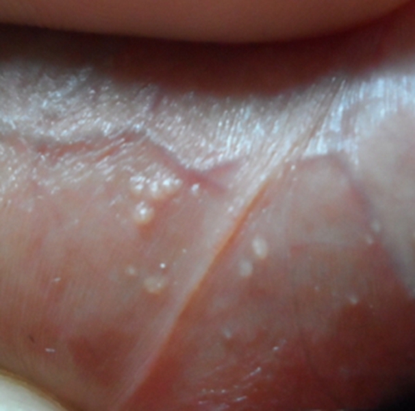 什么是龟头包皮炎图片_有来医生