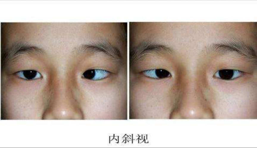 急性内斜视