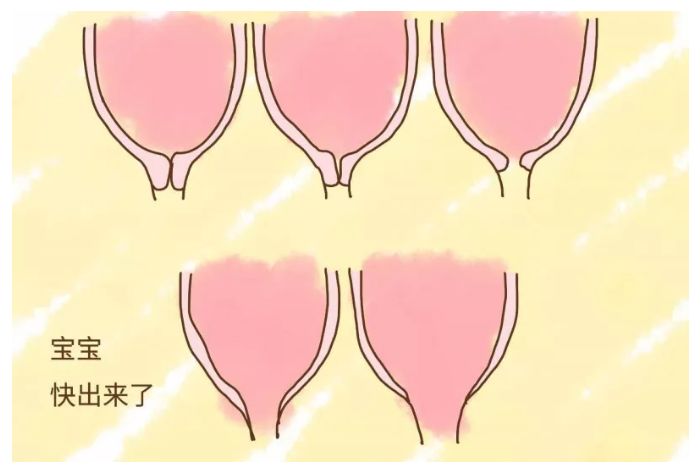 产科医生必须掌握的宫颈成熟度检查方法和要点你掌握了吗