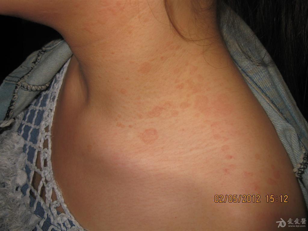 病例分享花斑癣2