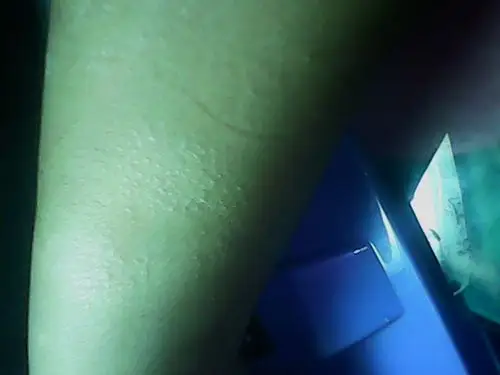 鸡皮疙瘩【多图】_39医疗图集-39健康网