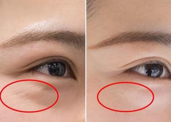 鱼尾纹和笑纹图片对比笑纹和鱼尾纹怎么去除