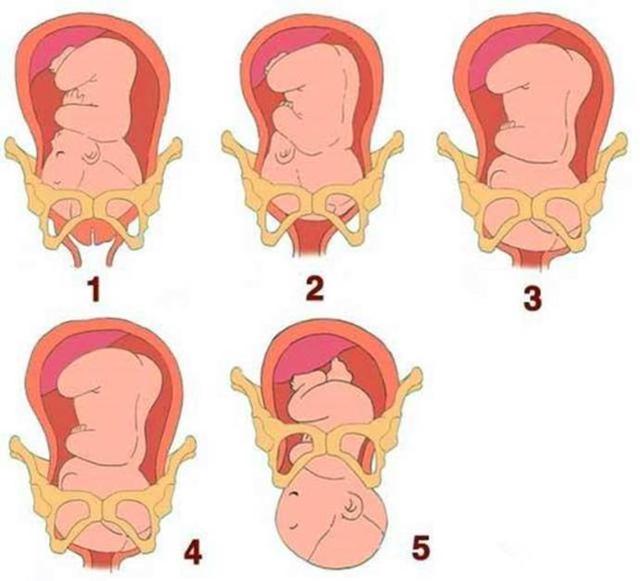 "慢性子"胎儿剖出,医生差点被熏吐,产妇:傻等入盆差点害了娃