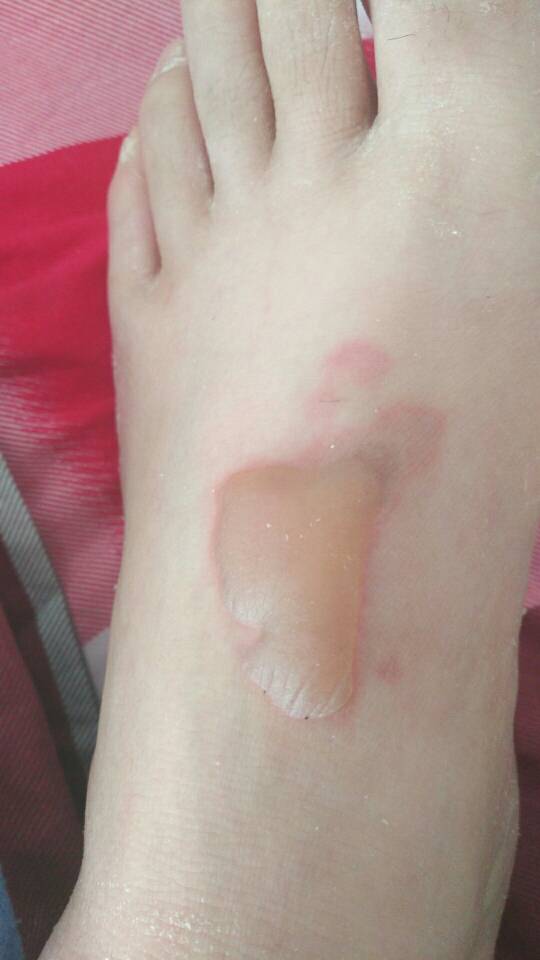 脚被蒸汽烫伤,起水泡,4天了,水泡还在,能不能挑破,会感染吗?