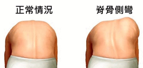 女孩患脊柱侧弯的机会比男孩高这样给孩子自查