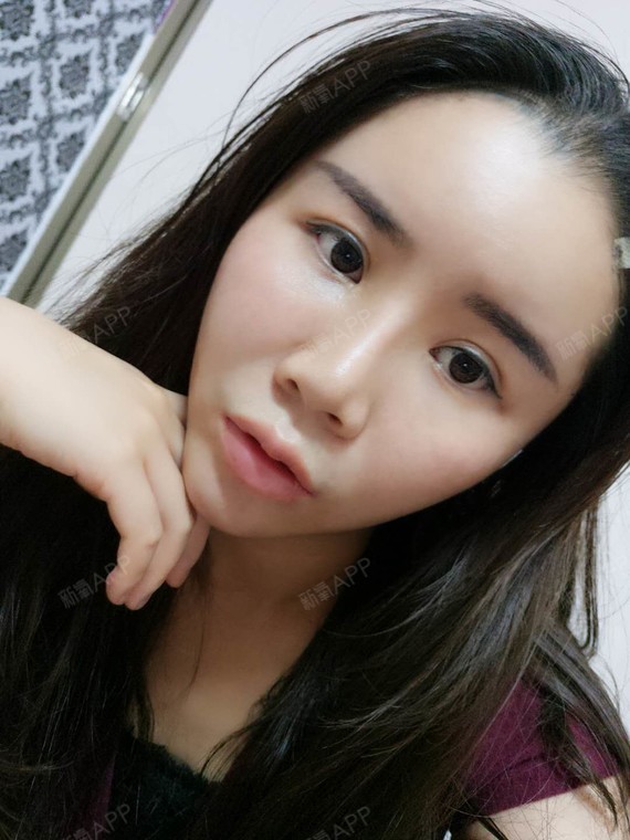 自体脂肪面部填充