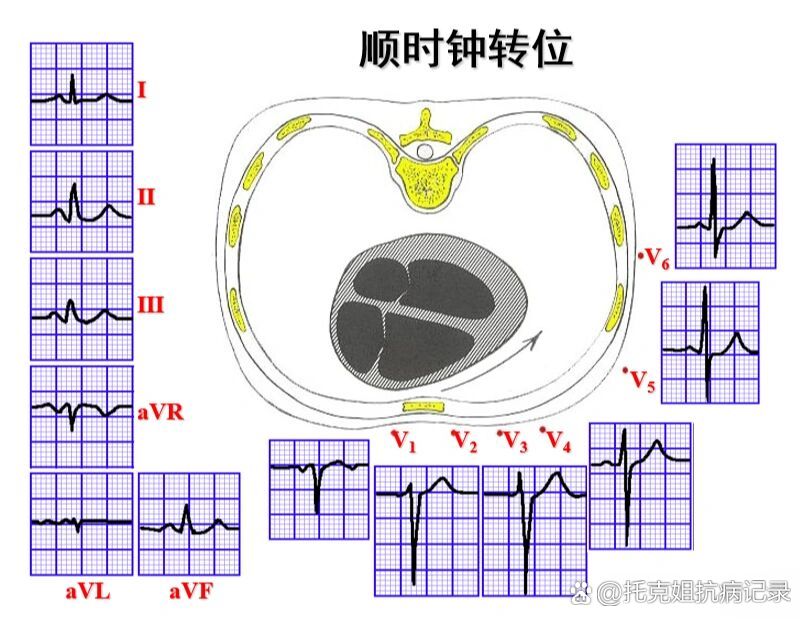 心电图电轴速记