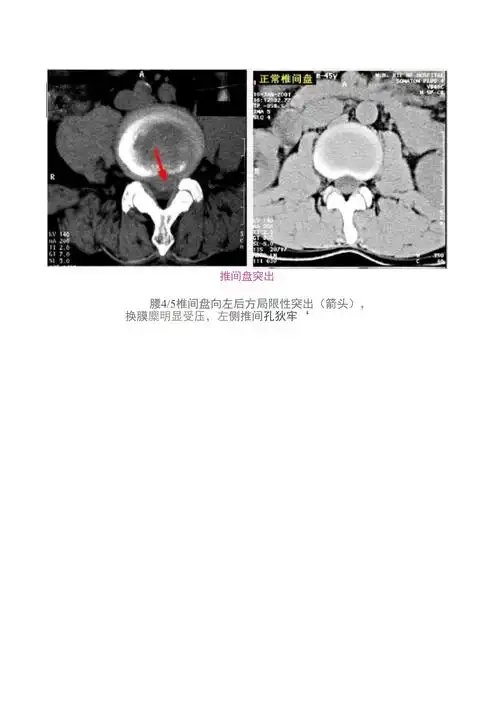 腰椎间盘突出ct诊断