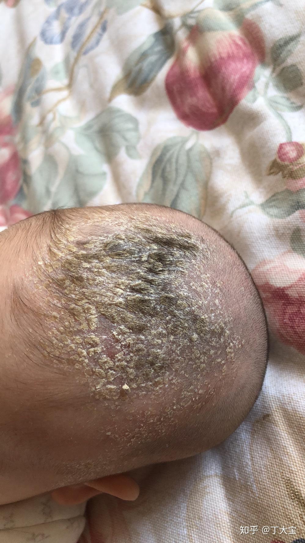 见过的最大头皮屑多大? - 知乎