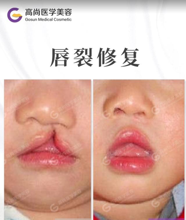 兔唇和吃兔肉有关吗?