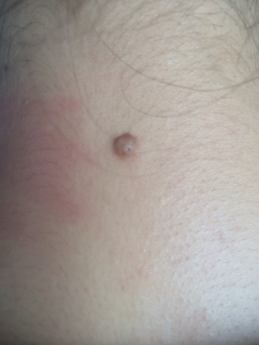 各位大师,我脖子后面正中央有颗痣,有人说是瘊子,有人说是苦情痣,而且