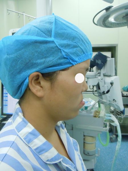 上颌低位水平截骨术lefort1治疗单侧唇裂术后颌骨畸形1