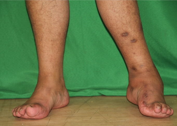 在发达国家,很多马蹄足患儿经过创伤很大的手术,结果畸形不能矫正且