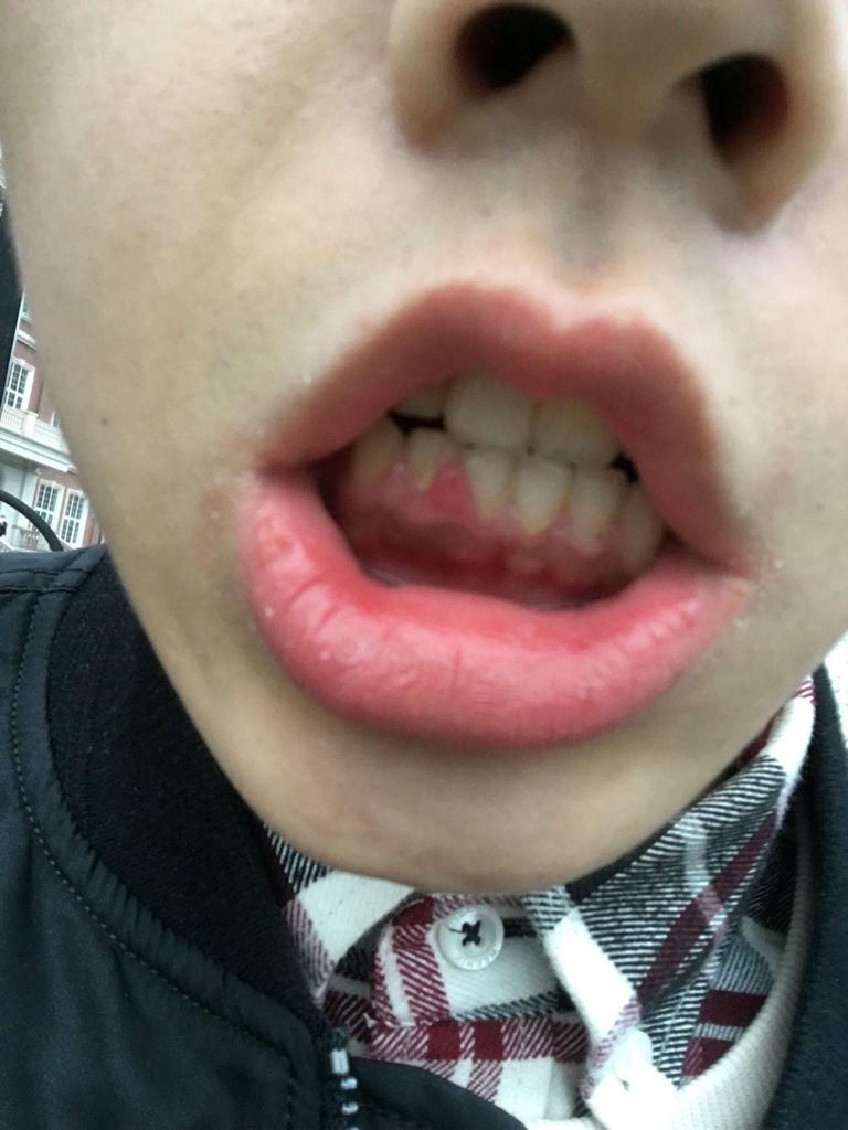 想问问牙龈这是怎么回事