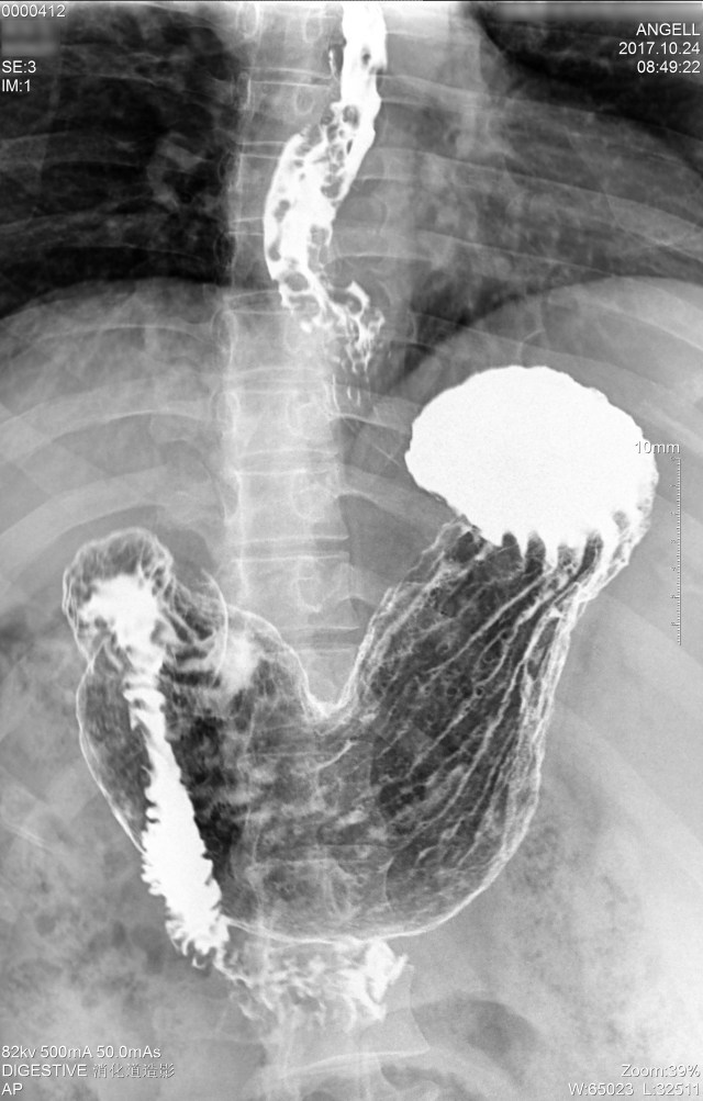 (图像 3-5) 食管静脉曲张粘膜相 超声胃镜,增强 ct,门静脉血管造影等