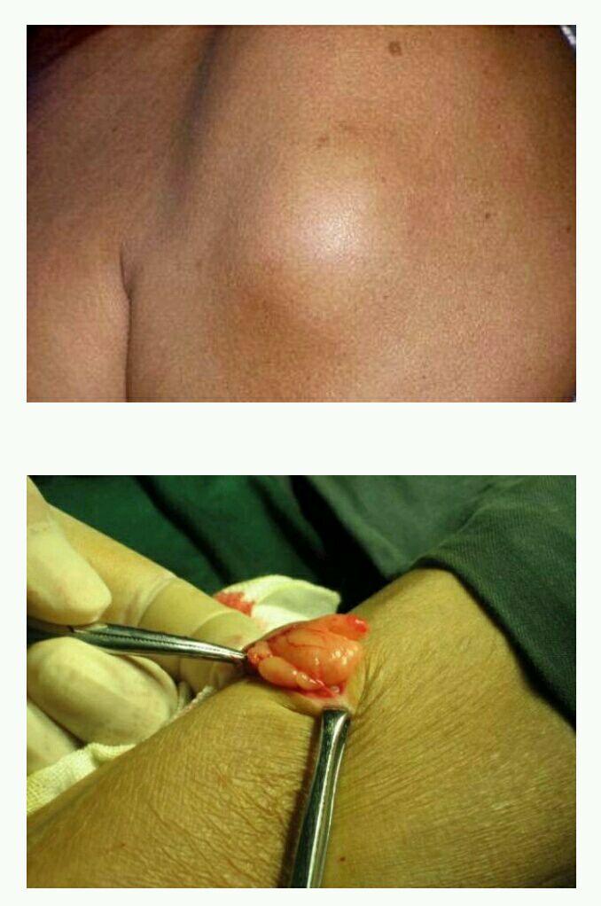 常见体表肿物——脂肪瘤