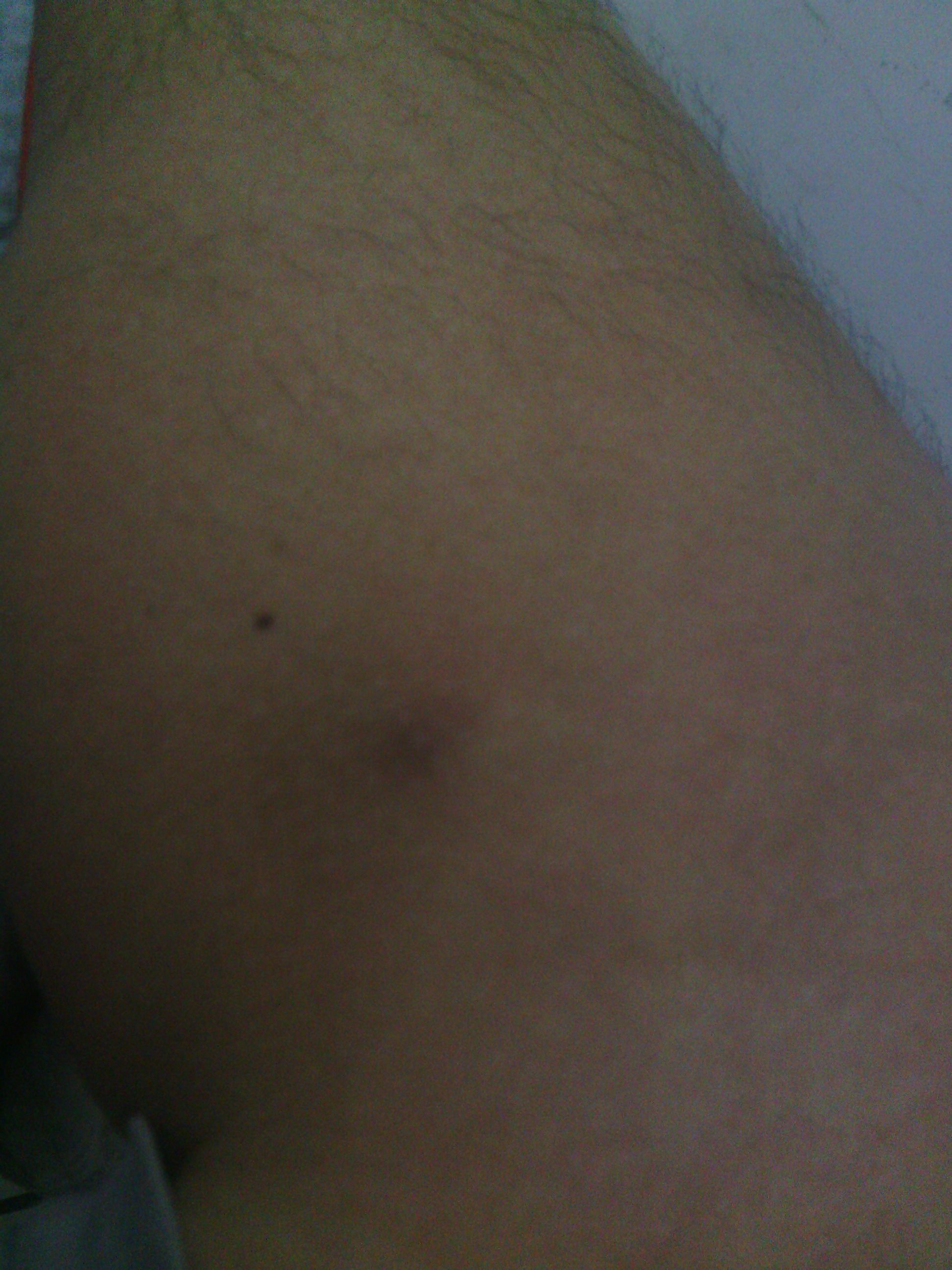 问:18年前腿上长了个小疙瘩,很小,碰到非常疼,平