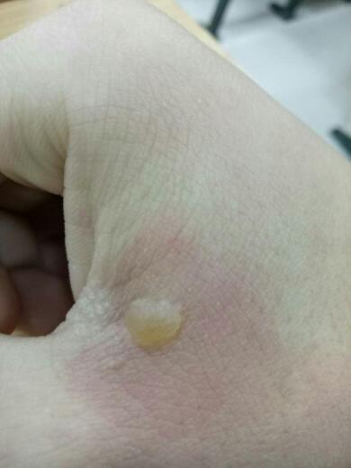 昨天手被烫到了,没处理好,今天起了个水泡,这样的情况怎么处理?