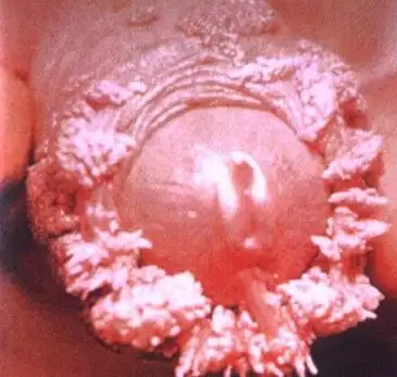 性病专家表示,男性尖锐湿疣的基本损害初起为细小淡红色小疙瘩,大小