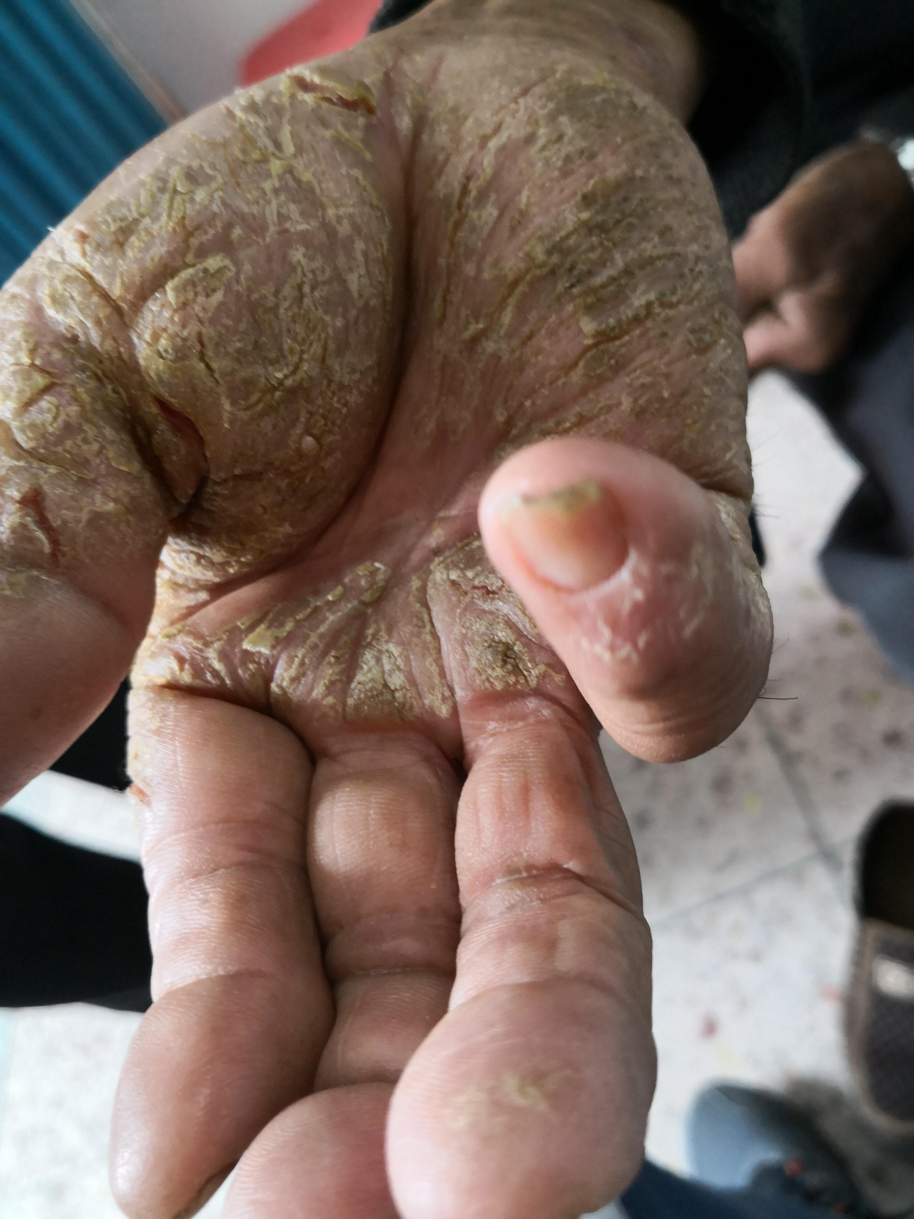 双手掌,双脚掌,对称性皲裂.请问这是什么皮肤病