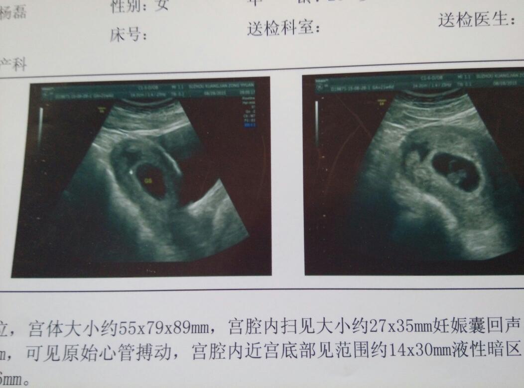 谁会看孕囊看男宝宝女宝宝哦,嘻嘻,我怀孕7周 4