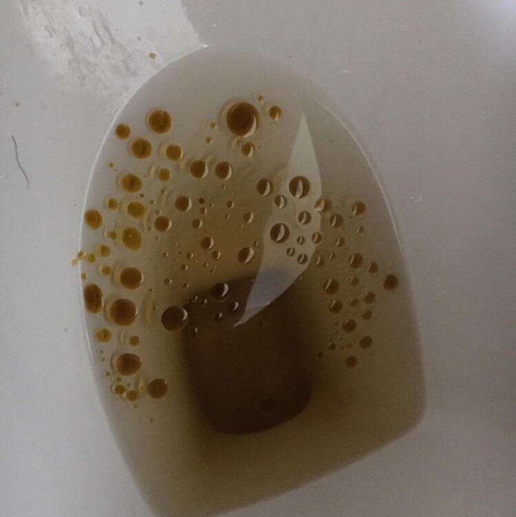 奥利司他只排油不能减重奥利司他副作用吓人吗74亲身经营那些吃过的